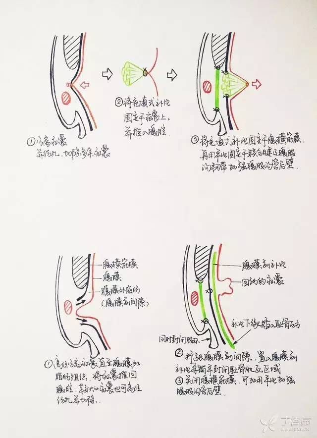 全國(guó)疝氣治療技術(shù)的革新與進(jìn)步，最新治療技術(shù)探索與力量展示