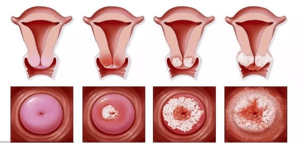 宮頸糜爛最新治療手段，為女性健康帶來新曙光